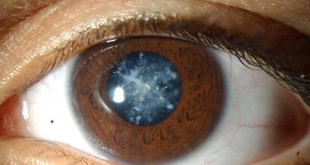 This article is about the major eye problems in human beings and their natural solutions. The eye is one of the most amazing organs in the body with incredible high precision and performance. All the muscles of the eye are in constant motion to perform three tasks simultaneously for vision.